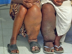 Sri Lanka, Maldives free of elephantiasis: WHO